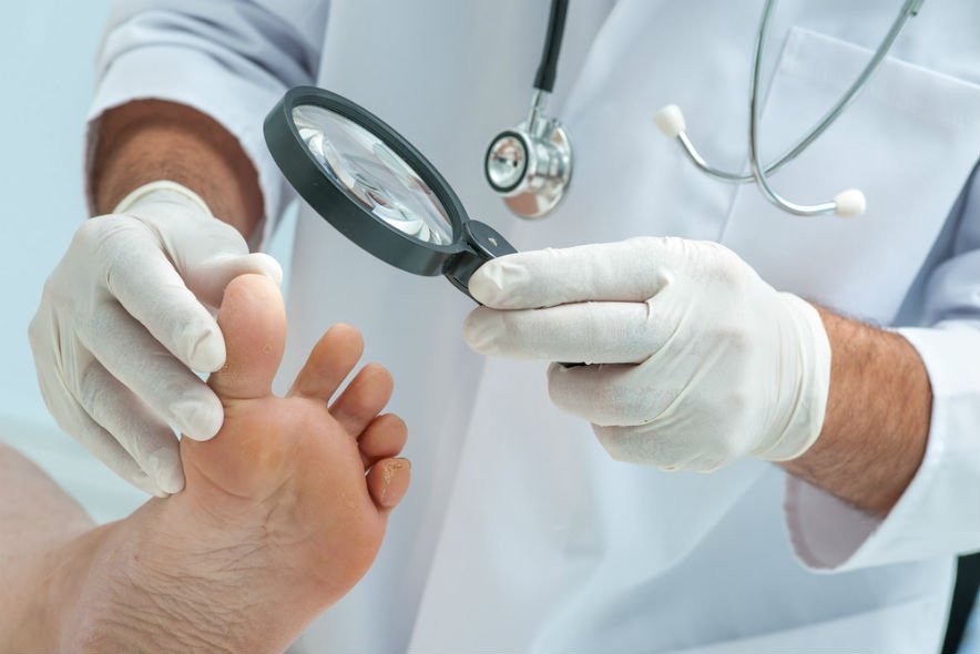 Кандидоз ногтей на ногах: симптомы и лечение