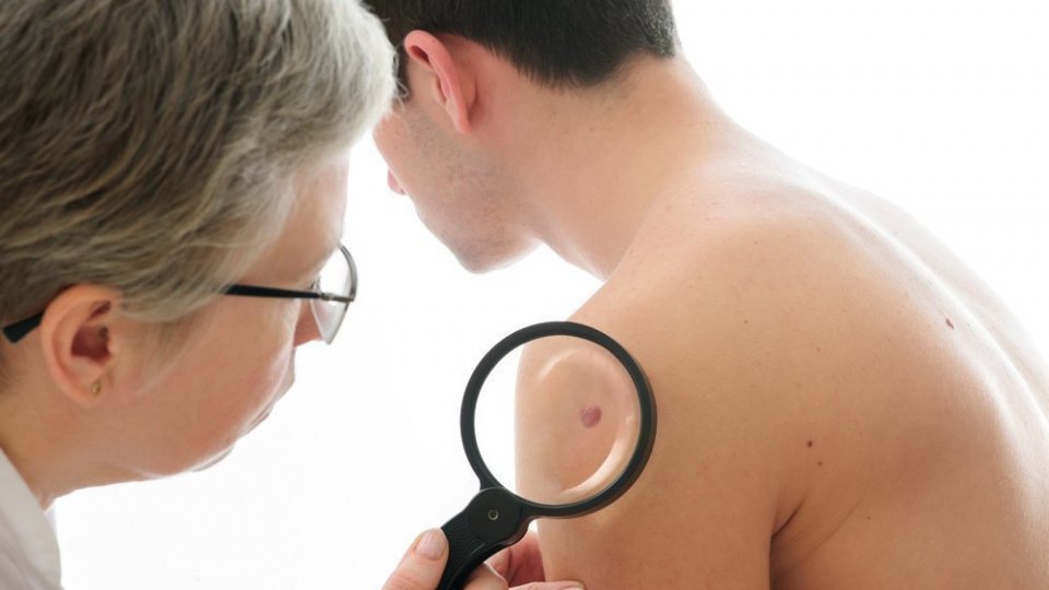 Базалиома кожи: симптомы и последствия