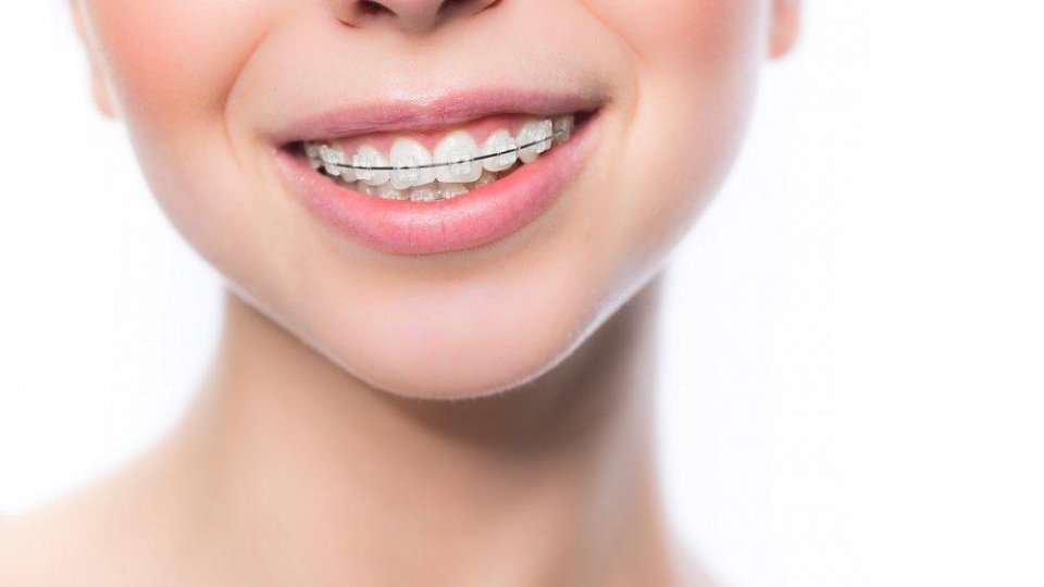 Диета при ношении брекетов: советы стоматологов
