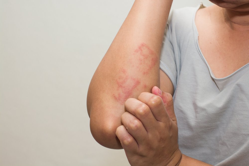 Симптомы токсико-аллергического дерматита