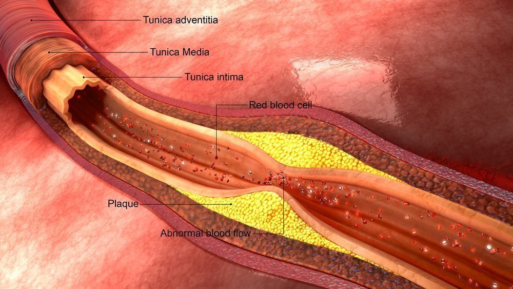 Как забиваются артерии?