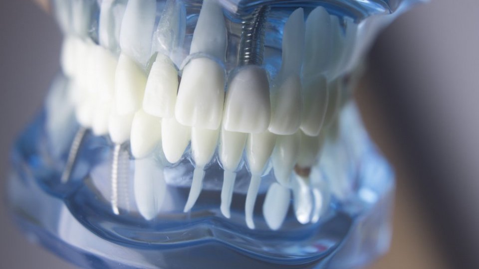 Осложнения после имплантации зубов: периимплантит