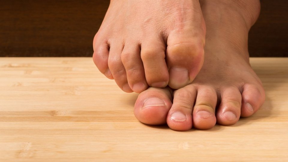 Стопа атлета – грибковая инфекция ног